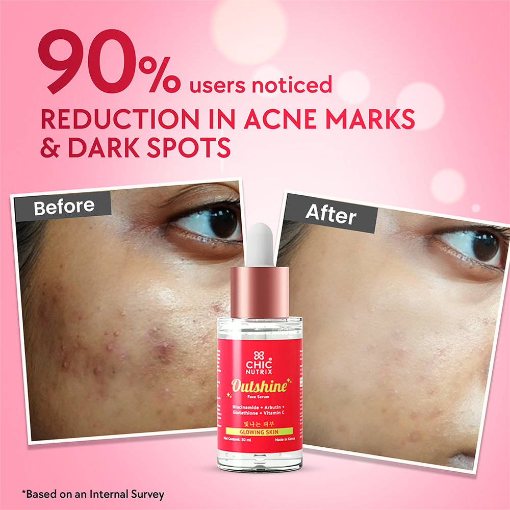 90% users noticed Reduction in ACNE MARKS & DARK SPORTS